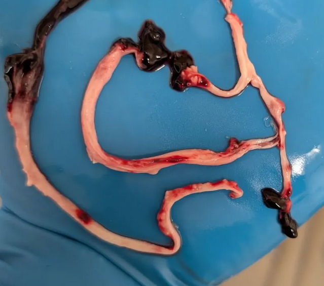 White Fibrous Clots and VAERS Data Manipulation: A Call for Urgent Investigation
